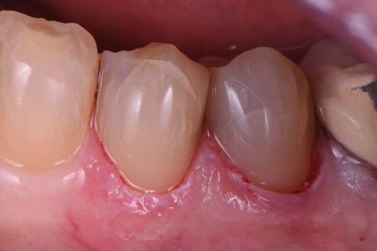 Cervical Abrasion Lesion Restorations Cervical Abrasion Lesion Restorations