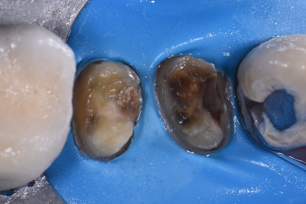 Dark Stump Shades Restored with Vitalescence