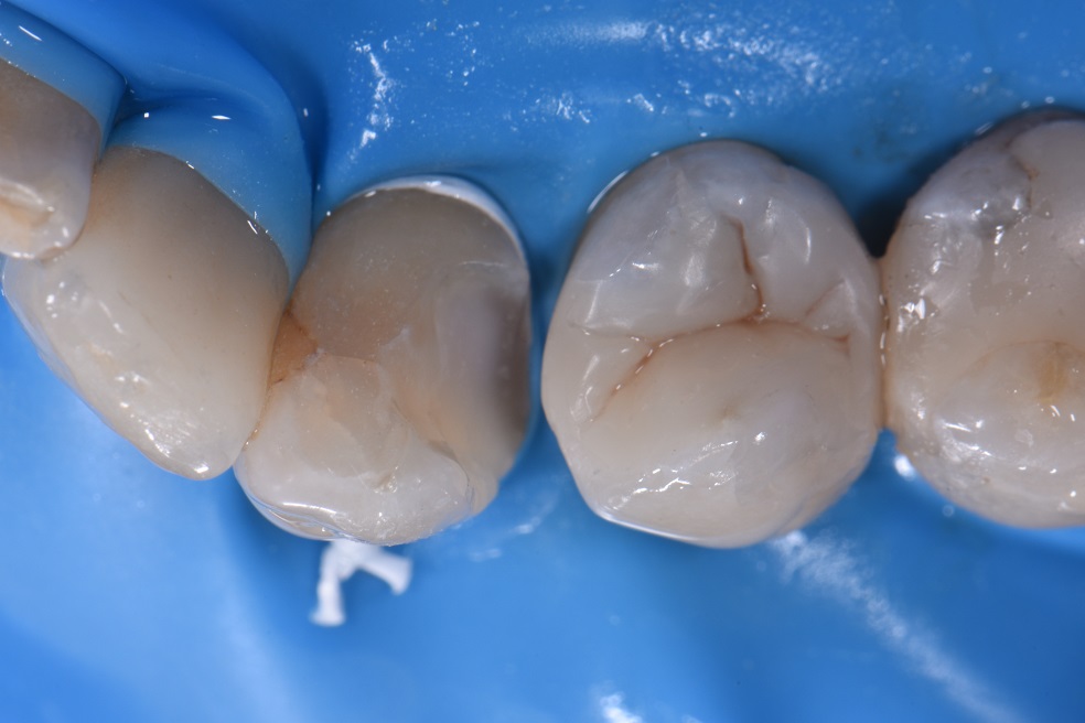 Marginal leakage on old composite fillings