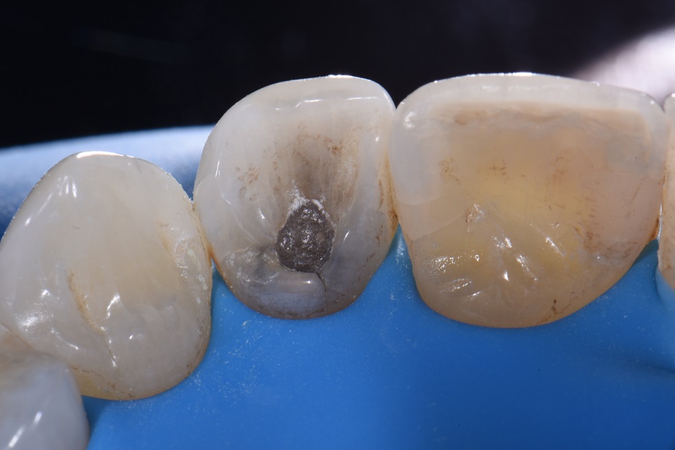 Dental Amalgam Removal Protocol Amalgam Removal Protocol