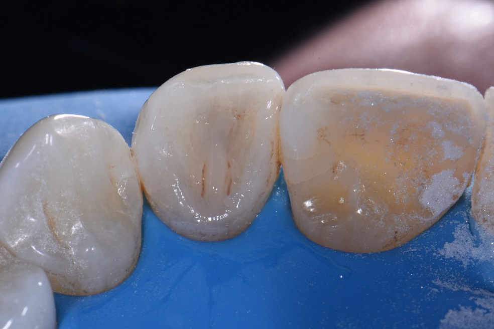 Dental Amalgam Removal Protocol Amalgam Removal Protocol