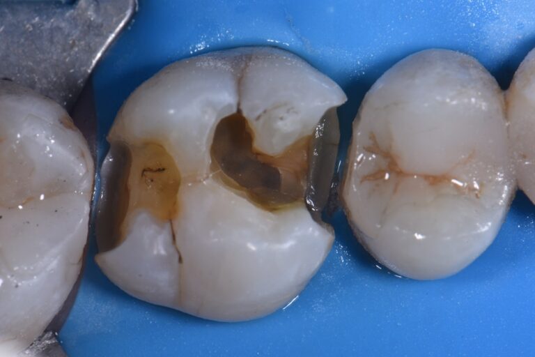 Cracked Amalgam Teeth Cracked Amalgam Teeth