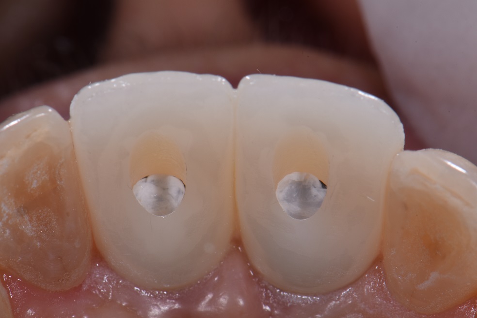 Zirconia Implant Crowns Zirconia Implant Crowns
