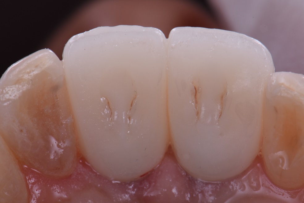 Zirconia Implant Crowns Zirconia Implant Crowns