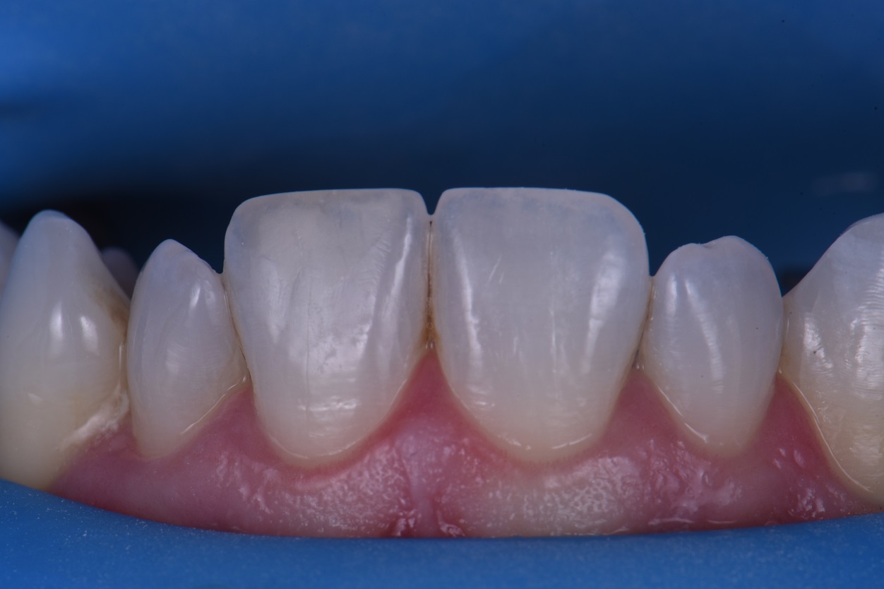 Peg Lateral Composite Veneer Transformation Peg Lateral Composite