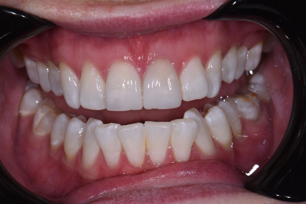 Dental Accident Repair Dental Accident Repair