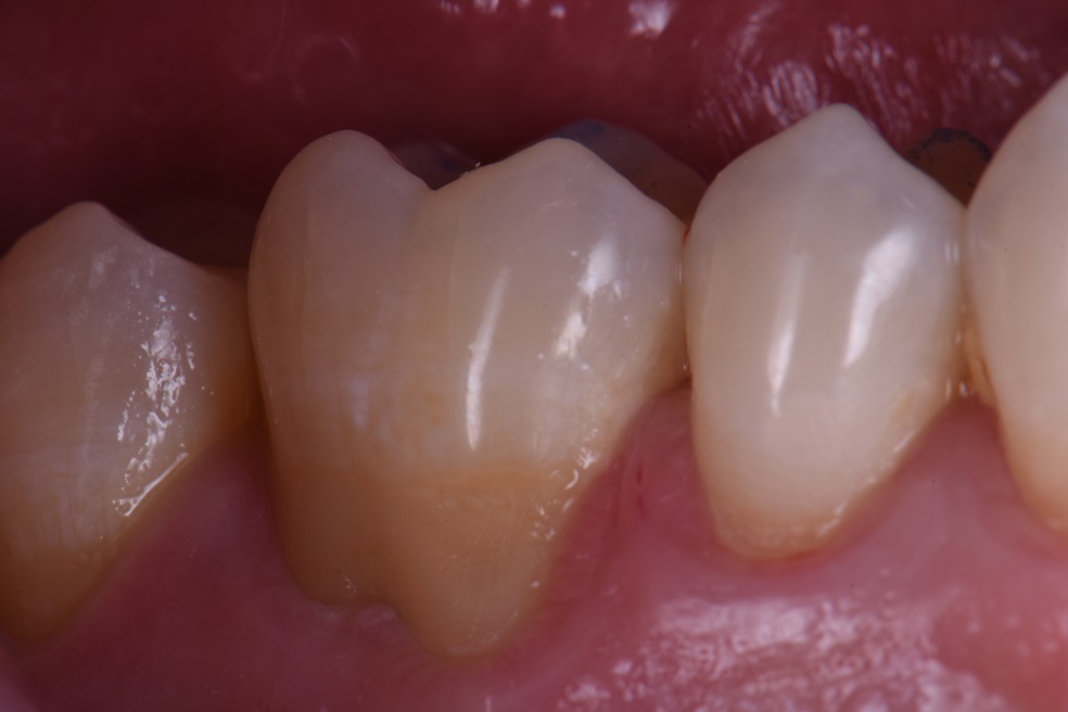 Root protection restorations