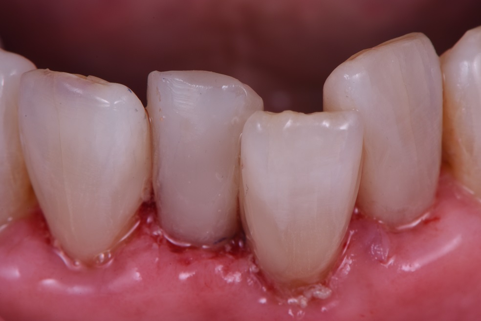 Rampant Decay Saving Hopeless Teeth Rampant Decay Saving Hopeless Teeth