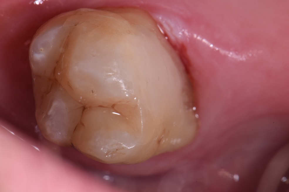 Cavities on Anchor Teeth for Dentures