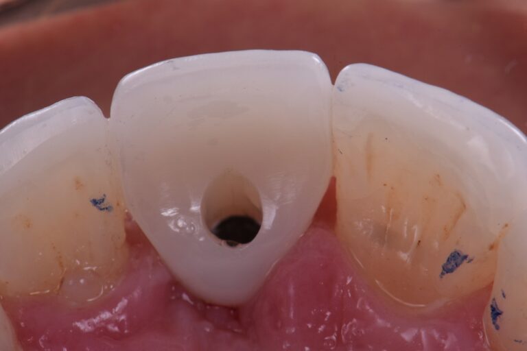 Dental Implant Angled Screw Channel Dental Implant Angled Screw Channel