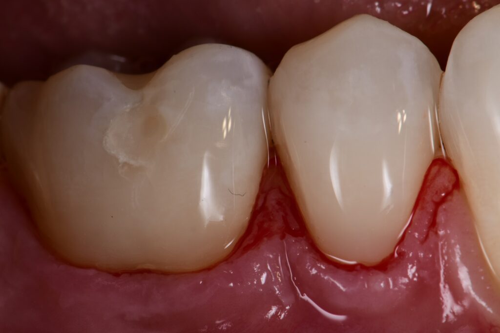 Abrasion Lesions Restored with Composite Abrasion Lesions Restored with