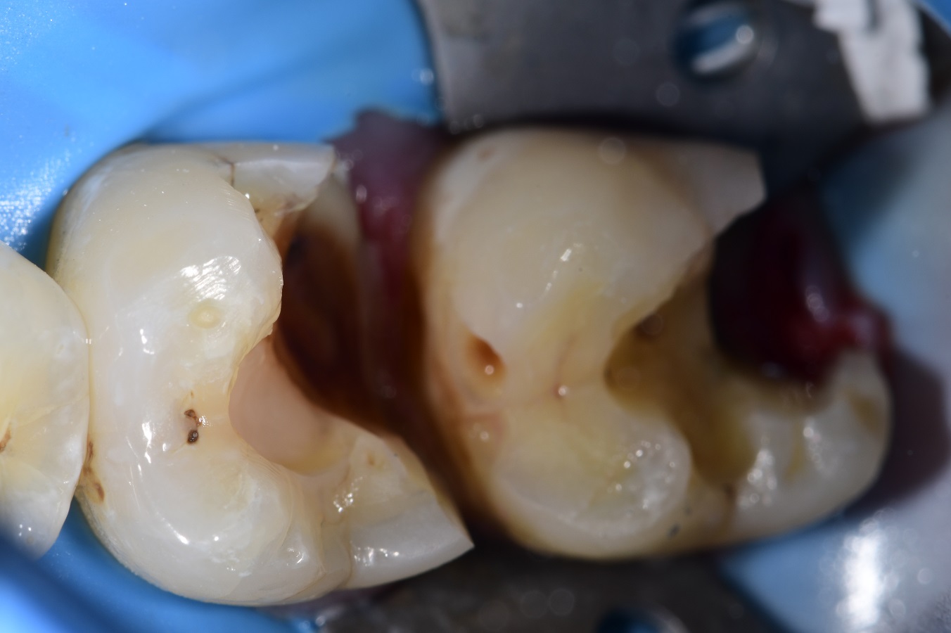 Mesial Drift and Root Proximity Restorations Mesial Drift and Root Proximity Restorations
