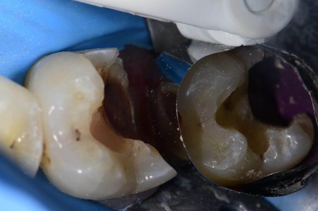Mesial Drift and Root Proximity Restorations Mesial Drift and Root Proximity Restorations
