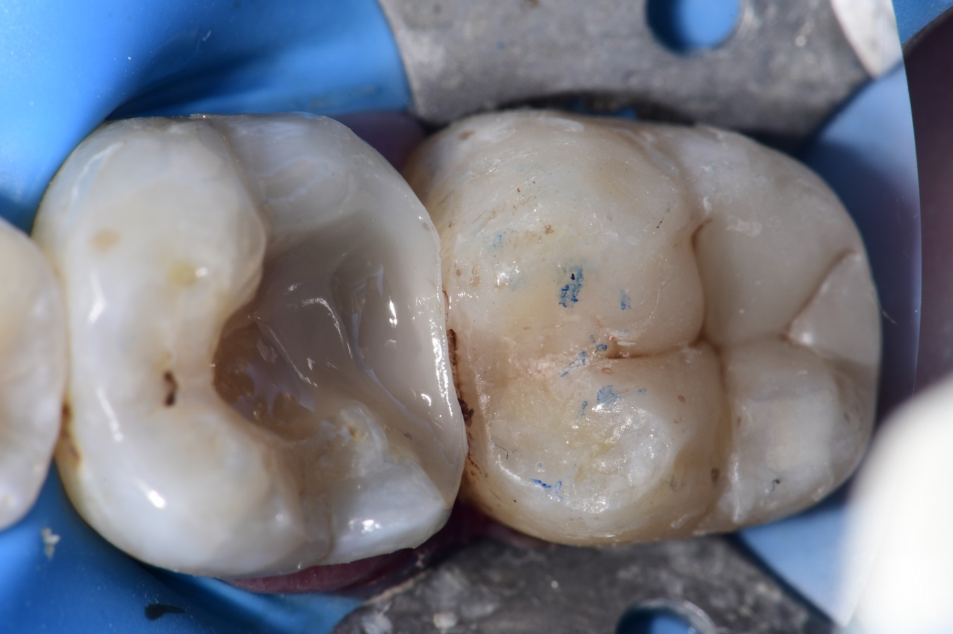 Mesial Drift and Root Proximity Restorations Mesial Drift and Root Proximity Restorations