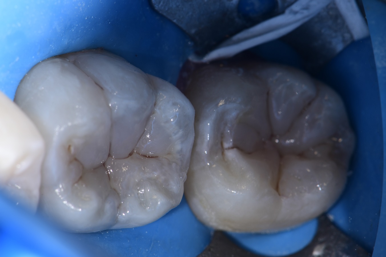 Replacing Amalgams and Blocking Dark Stain Class I anatomy