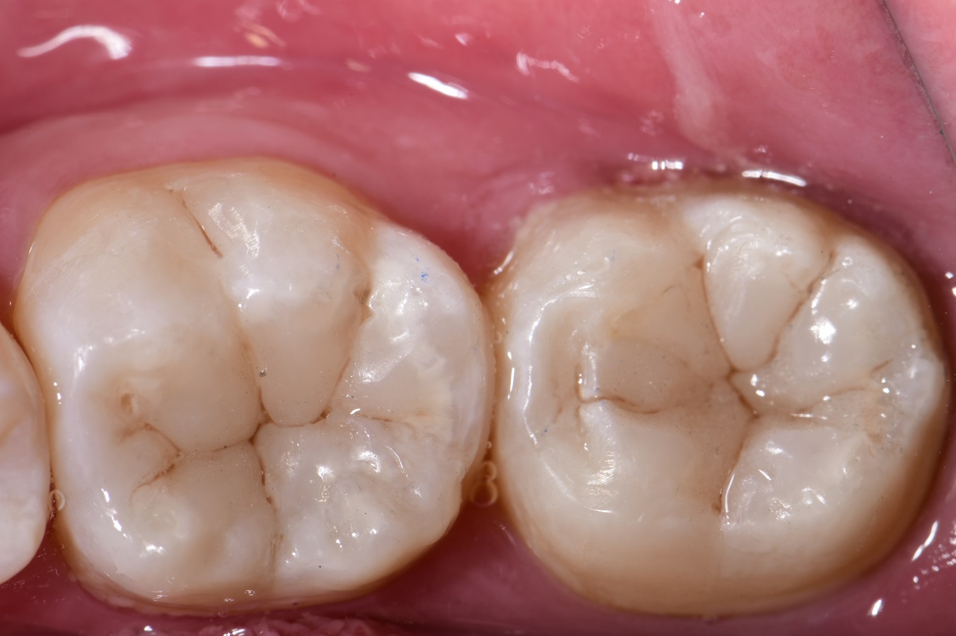 Replacing Amalgams and Blocking Dark Stain Class I anatomy