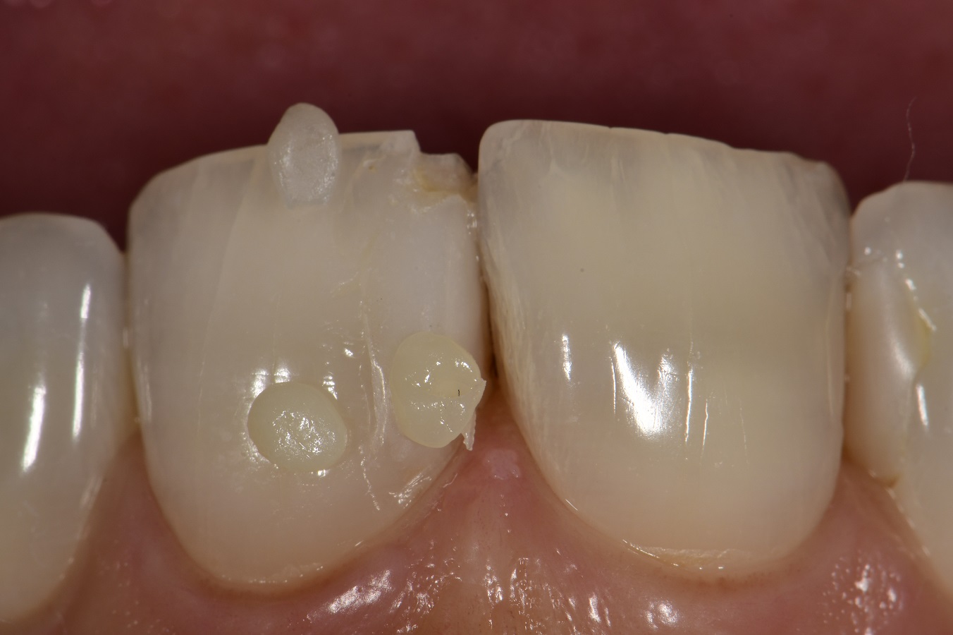 Anterior Composite Esthetics Anterior Composite Esthetics