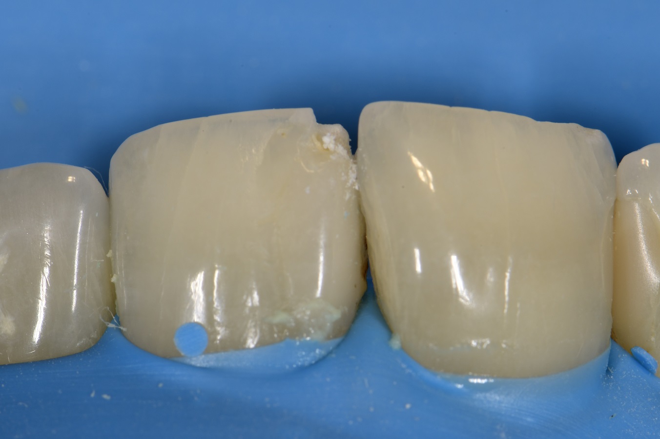 Anterior Composite Esthetics Anterior Composite Esthetics