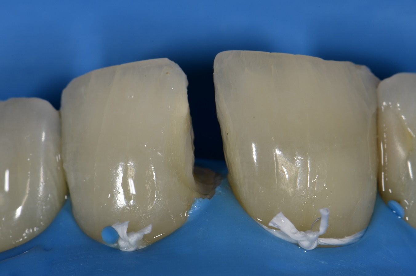 Anterior Composite Esthetics Anterior Composite Esthetics