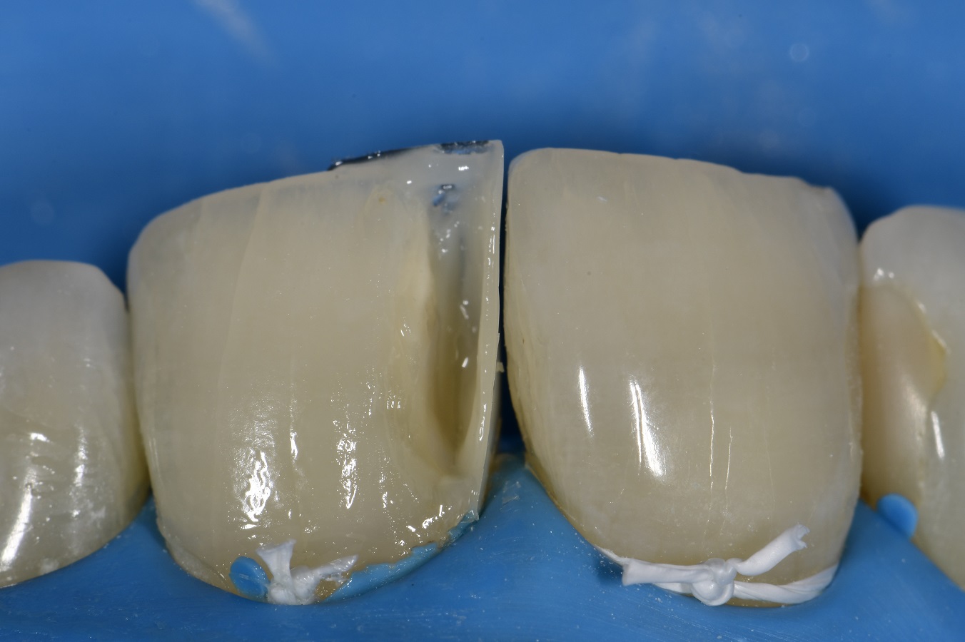 Anterior Composite Esthetics Anterior Composite Esthetics