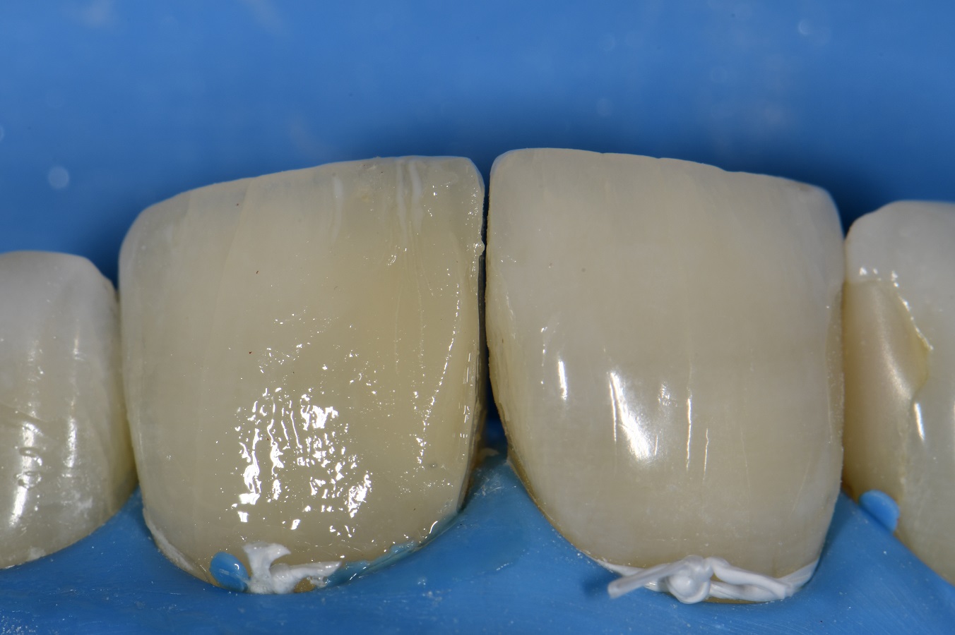 Anterior Composite Esthetics Anterior Composite Esthetics