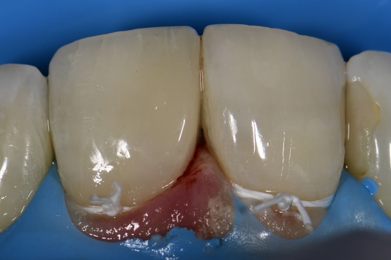 Anterior Composite Esthetics Anterior Composite Esthetics