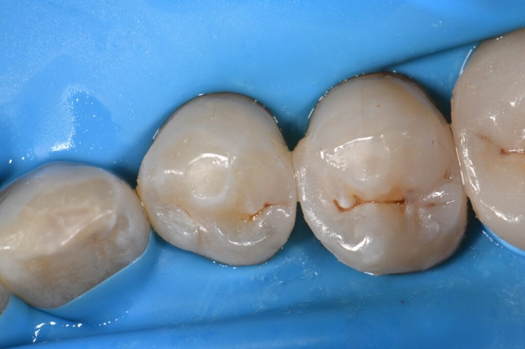 Invisible Class II composite restorations