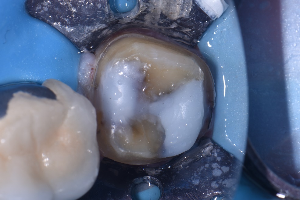 Cracked Molar