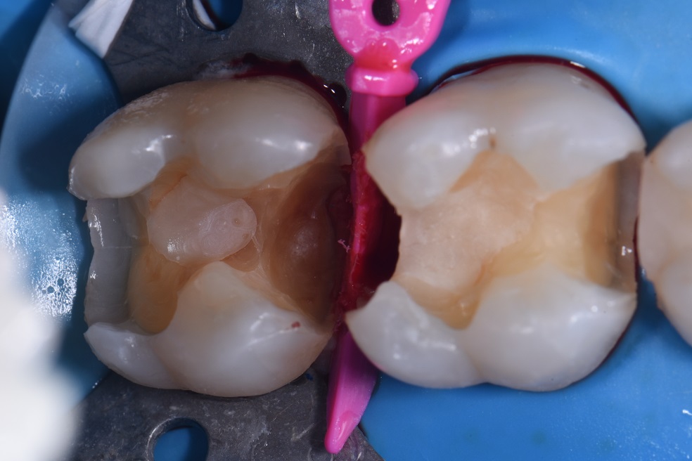 Deep Crestal level Dental Caries Deep Crestal level Dental Caries