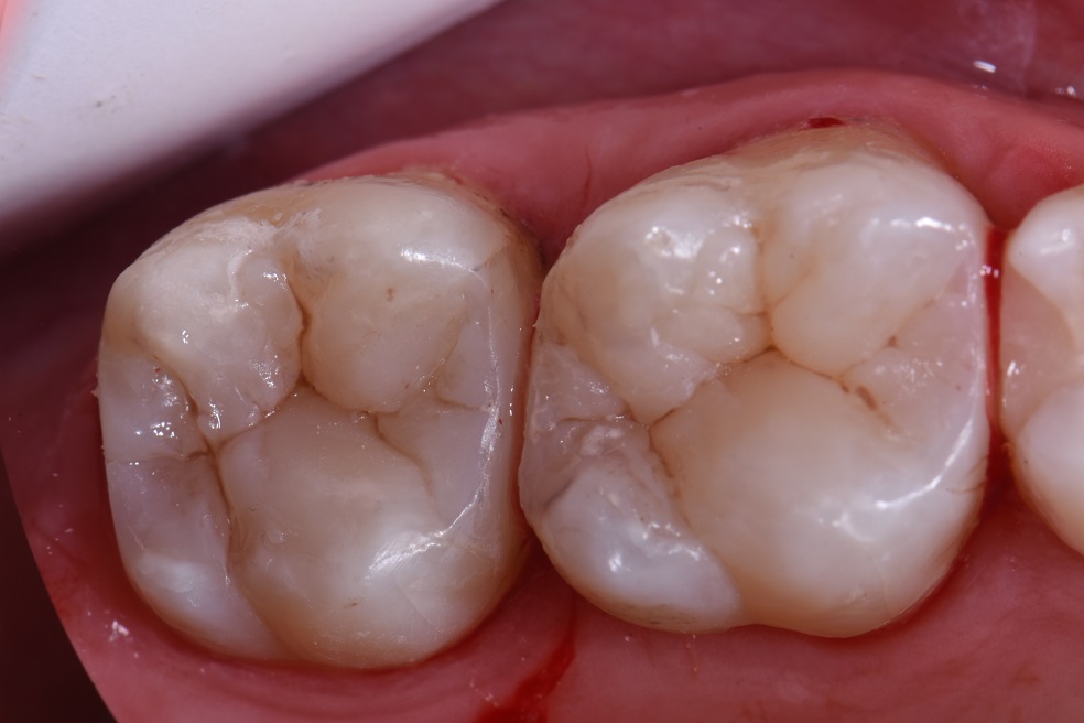 Deep Crestal level Dental Caries Deep Crestal level Dental Caries