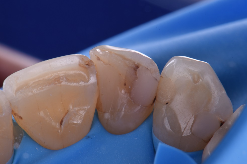 Dental Reconstructions Composite Dental Reconstructions Composite