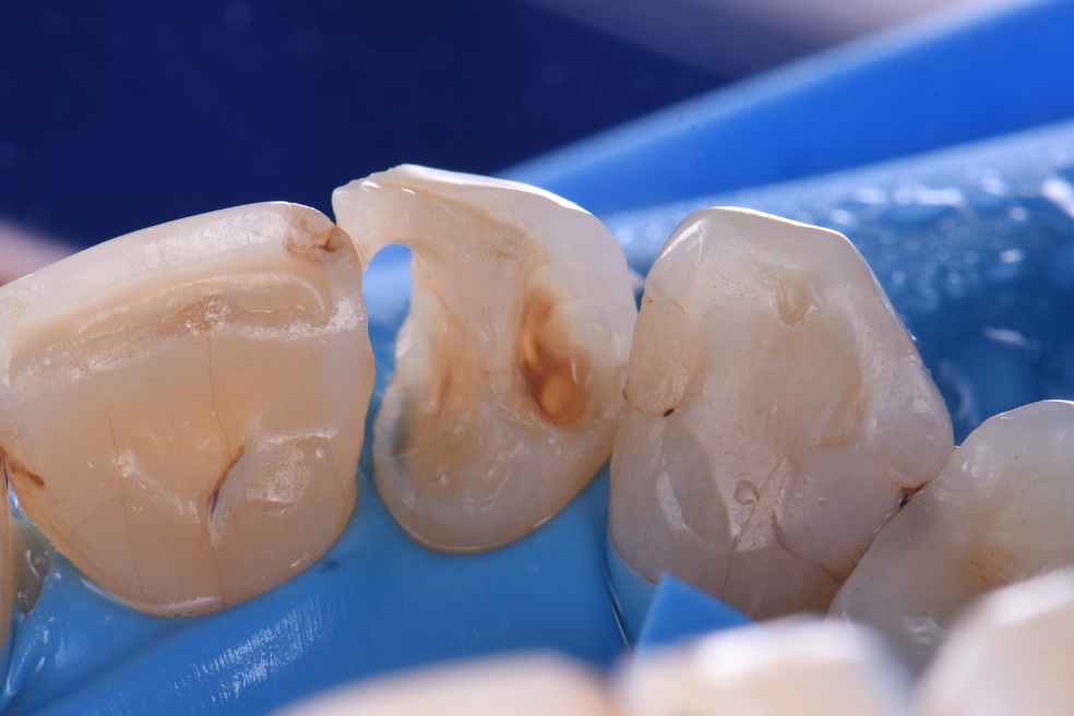 Dental Reconstructions Composite Dental Reconstructions Composite