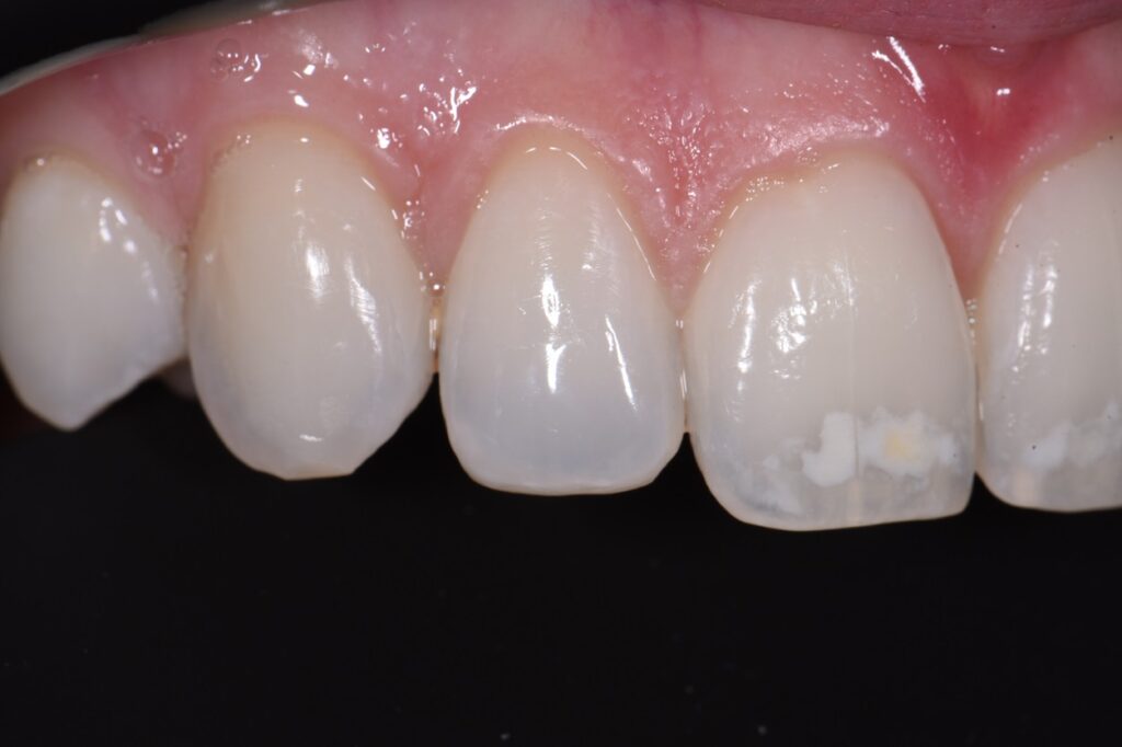 Resin Bonding to Tweak Shapes of Teeth