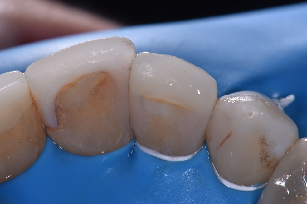 Clean Precise Class III restorations