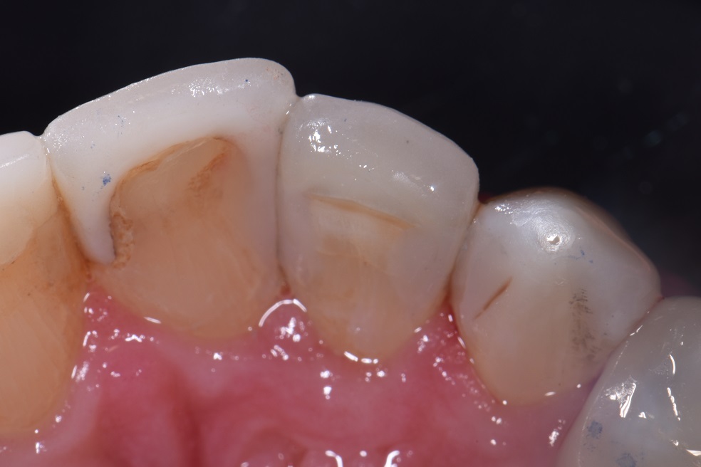 Clean Precise Class III restorations