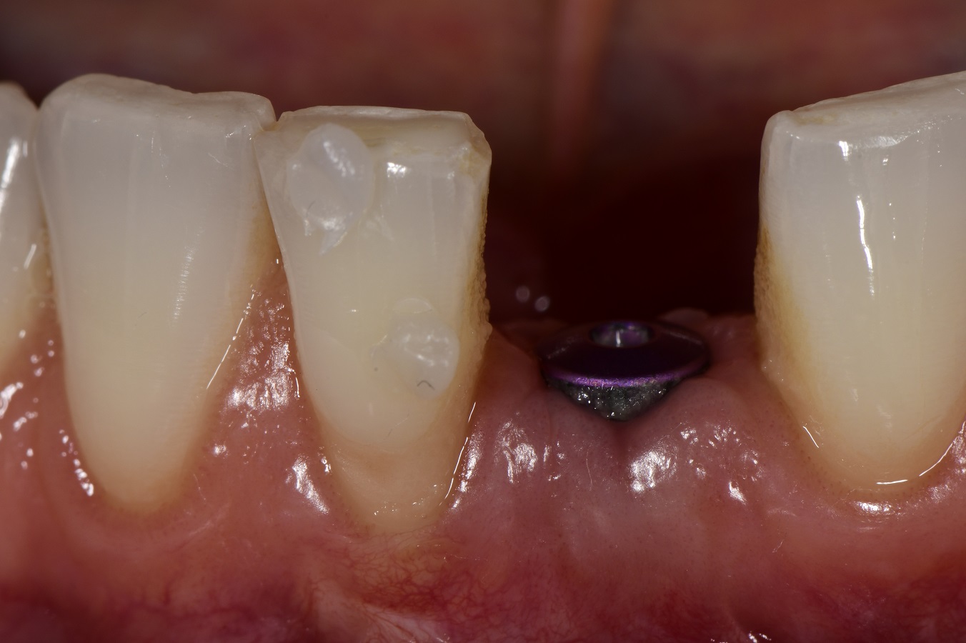 Composite Restoration Next to Implant Crown Composite Restoration Next