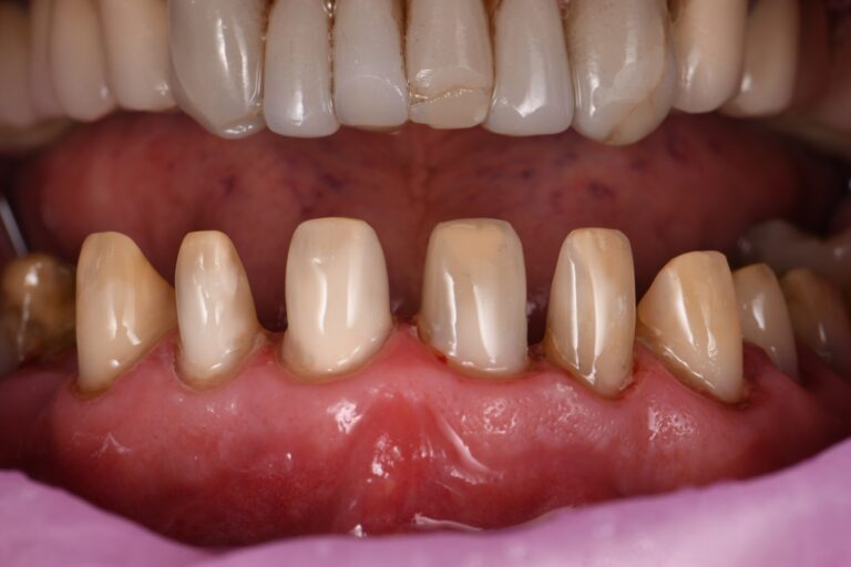 Preparations for New Bonded Porcelain Crowns Preparations for New