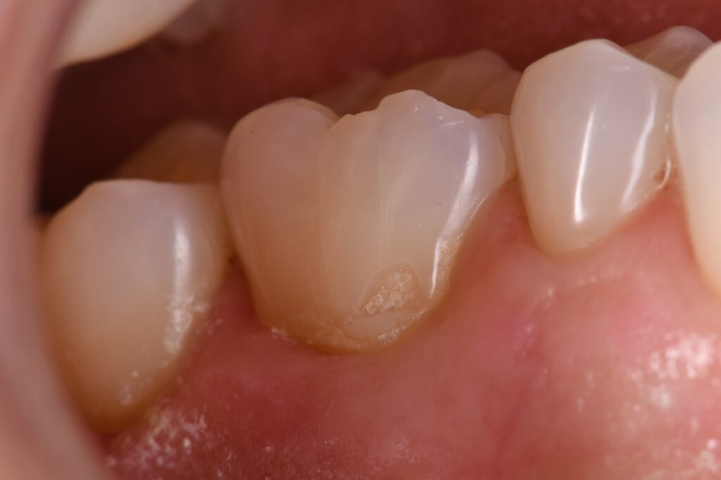 Chipped Enamel | Invisible Restorations