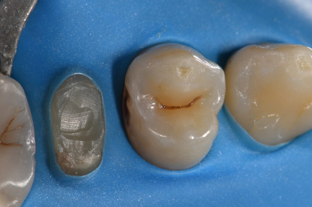 Slot Restoration Matrix in Matrix Technique Slot Restoration Matrix