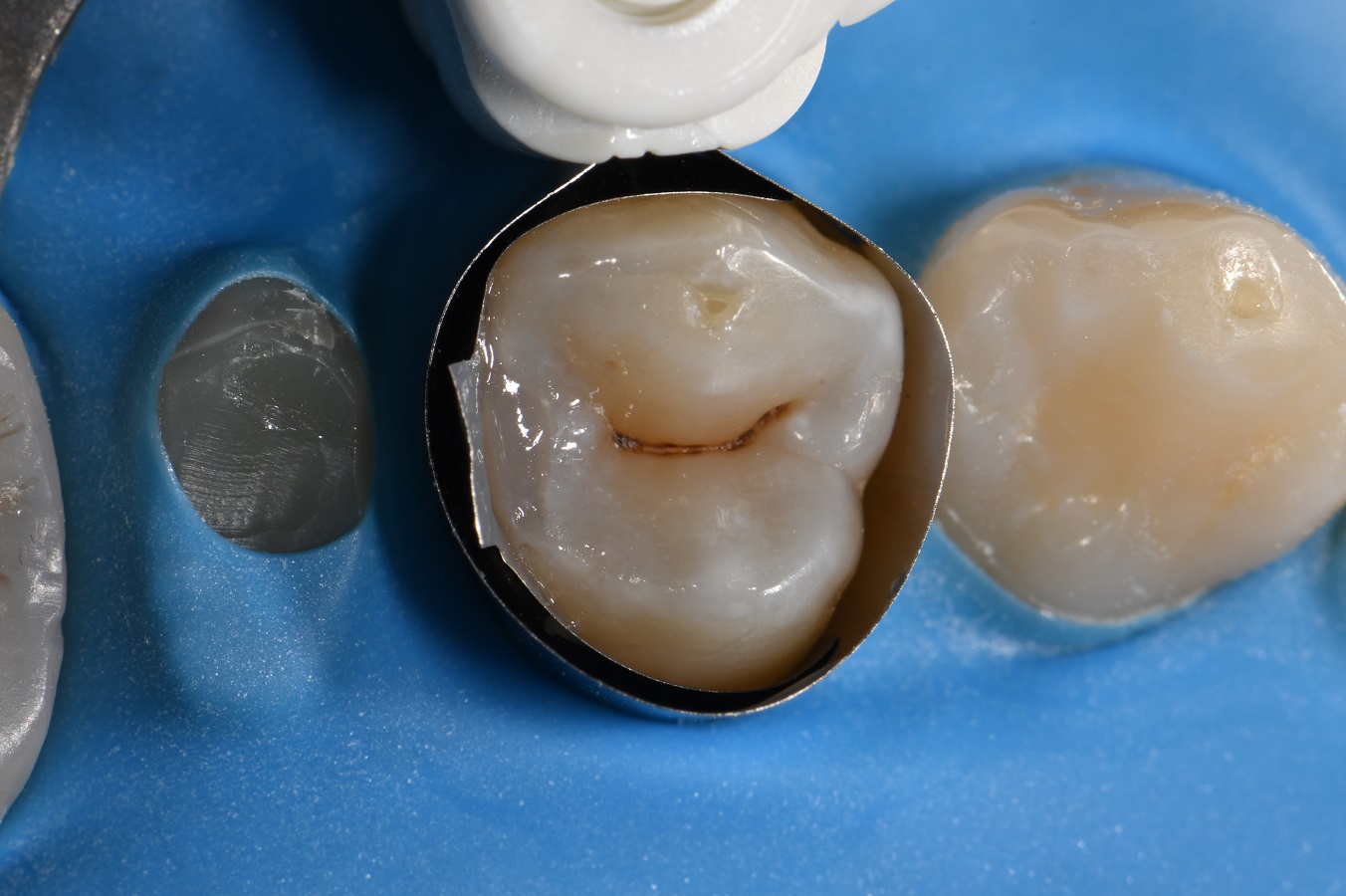 Slot Restoration Matrix in Matrix Technique Slot Restoration Matrix