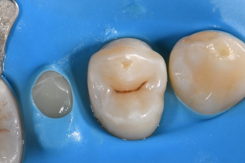 Slot Restoration Matrix in Matrix Technique Slot Restoration Matrix