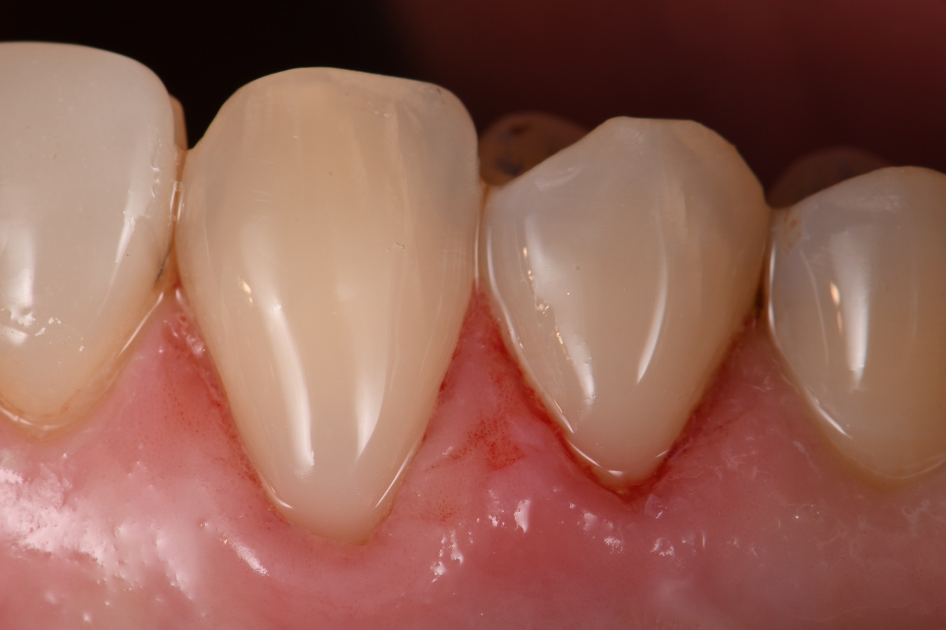 Eliminating root sensitivity Eliminating root sensitivity