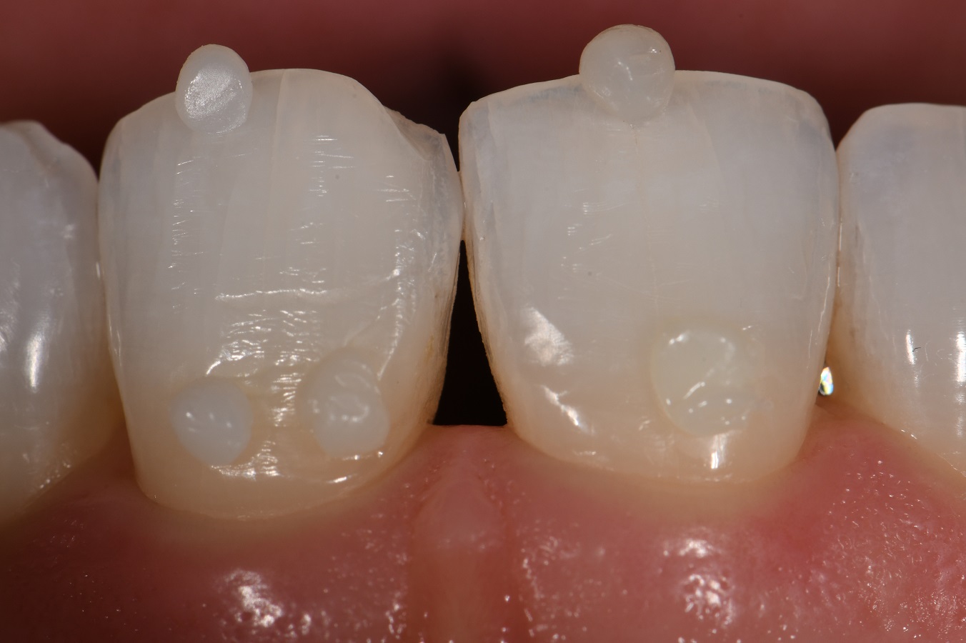 Post Orthodontic Composite Bonding Post Orthodontic Composite Bonding