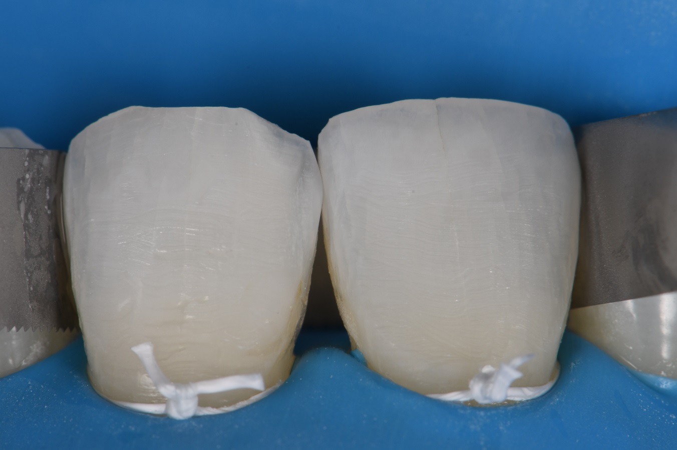 Post Orthodontic Composite Bonding Post Orthodontic Composite Bonding