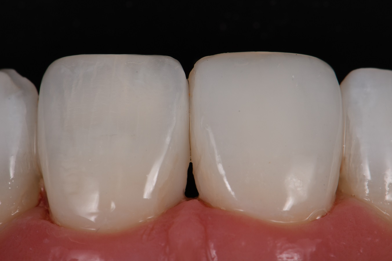 Post Orthodontic Composite Bonding Post Orthodontic Composite Bonding