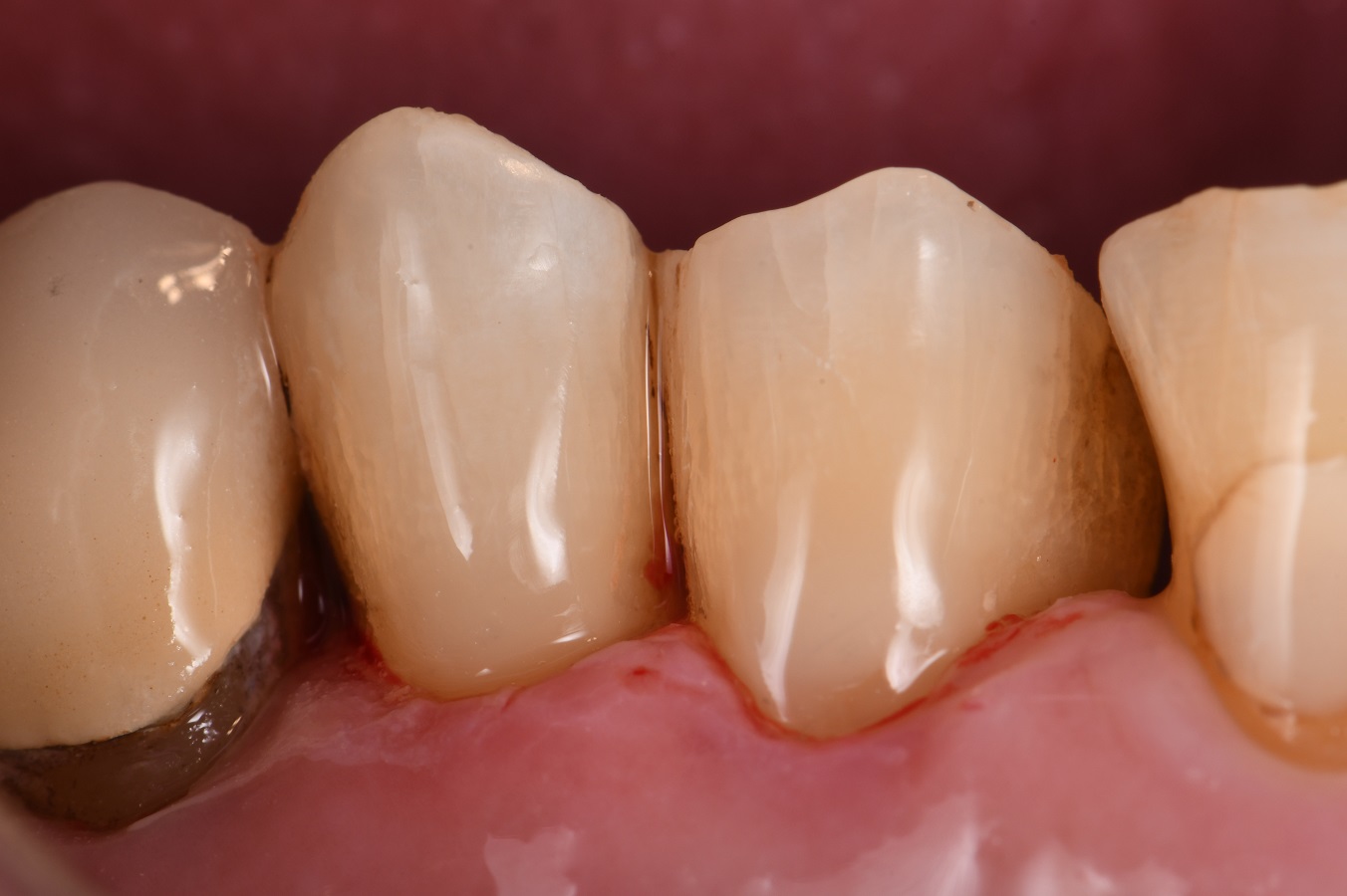 Class V full silanated composite resin Class V full silanated composite