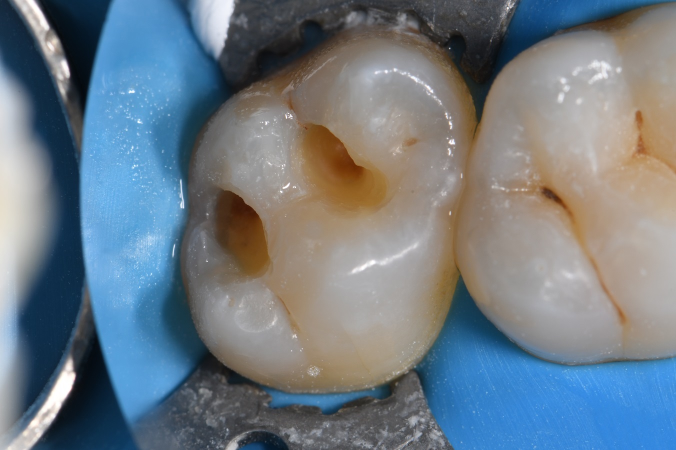 Insidious Dental Cavities Caries Insidious Dental Cavities Caries