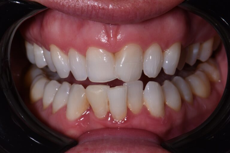 SureSmile PreProsthetic Orthodontics Ultradent Mosaic Composite Veneers