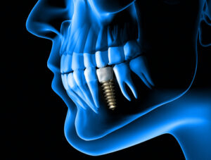 Tooth Implant