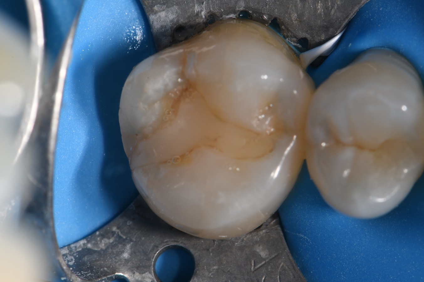 Composite Fillings Marginal Leakage and Failure Composite Fillings